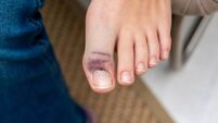 Left foot with bruised big toe